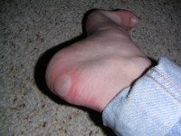A big blister!