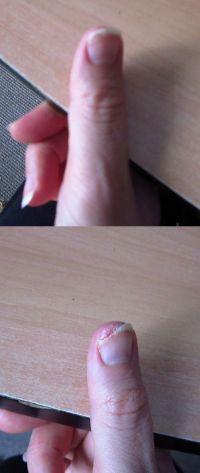 Infected thumb