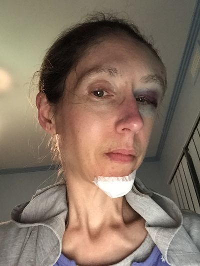 My facial injuries after visit to ED