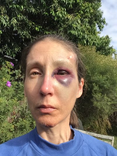 My facial injuries, 48 hours later