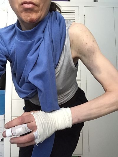 Injuries to my left arm and hand