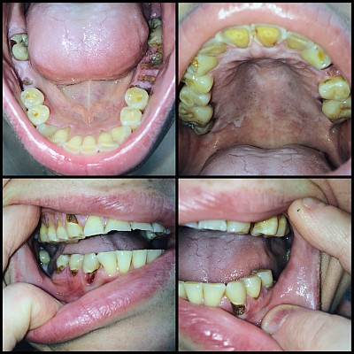Teeth damaged by bulimia
