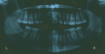 Teeth x-ray