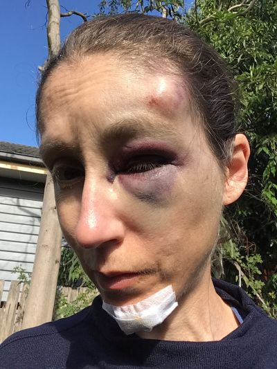 My bicycling accident injuries, 12/5/2020